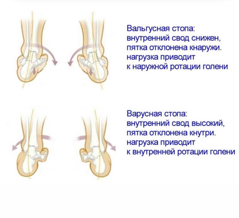 Устілки ортопедичні індивідуальне виготовлення за 30 хвилин - відправка по Україні