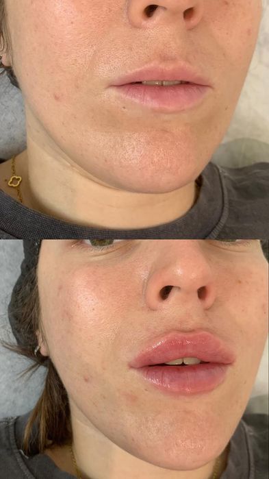 Увеличение губ ,индивидуальный подход. Сертифицированные препараты