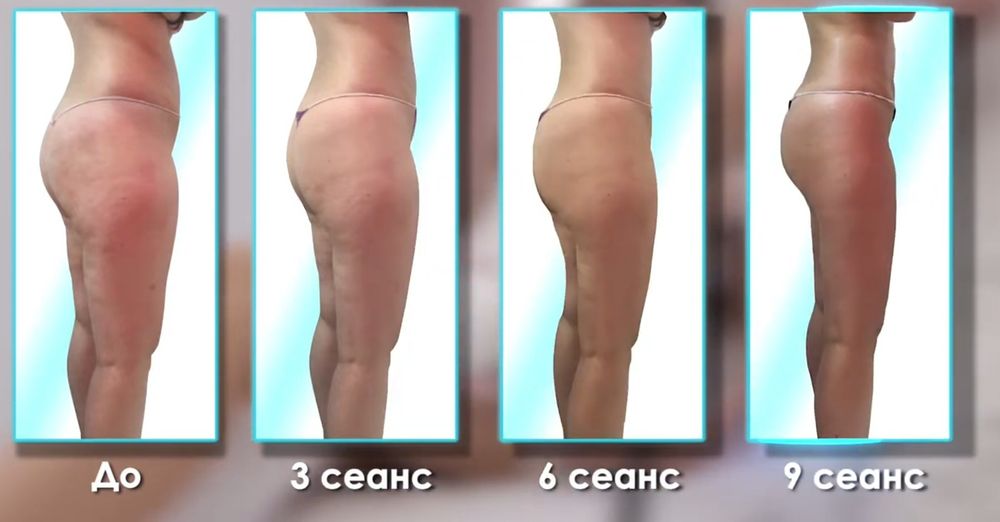 Ударно-импульсный ,вакумый термомассаж  Drumroll V-03