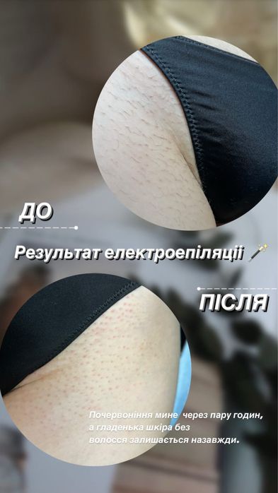 Електроепіляція / Електроепиляция