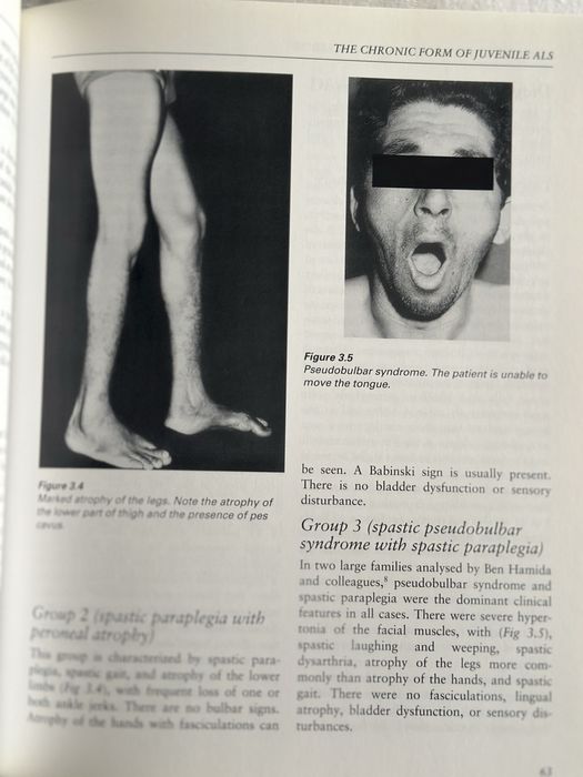 Amyotrophic Lateral Sclerosis