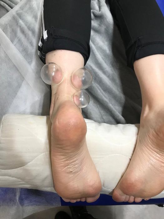 Stawianie baniek ogniowych lekarskich Dojazd do Pacjenta