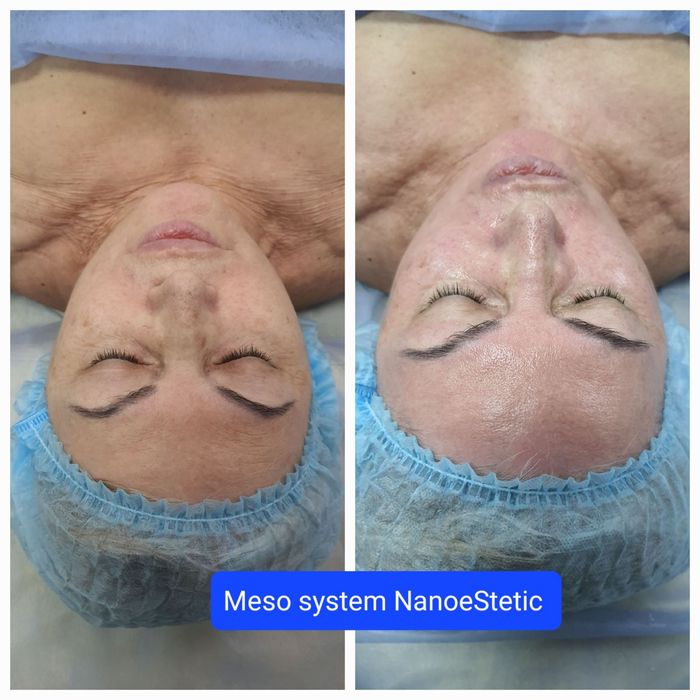 Лазерна епіляція