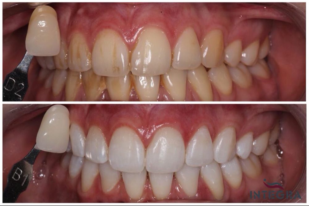 Лампа для відбілювання Magic Smile