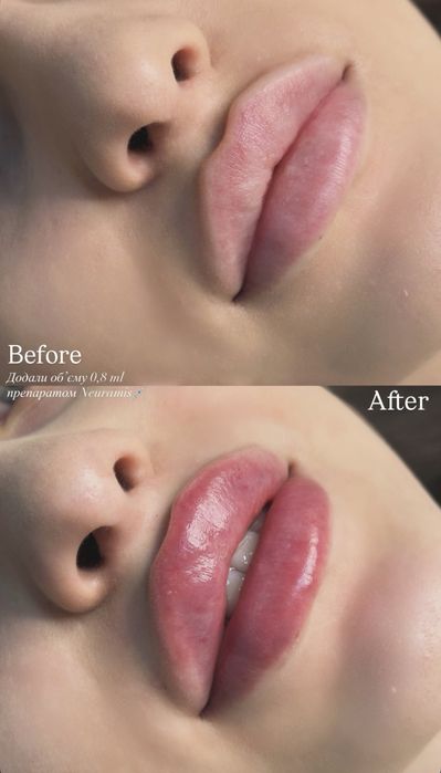 Контурна пластика губ, Біоревіталізація Акція!!!