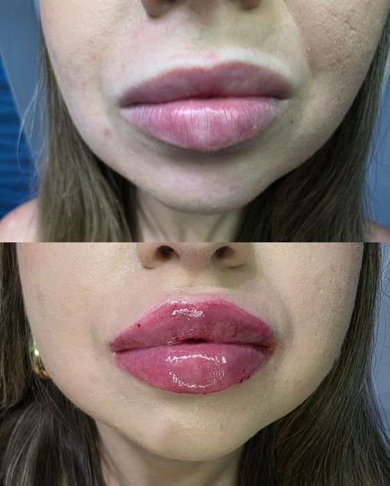Promocja! Botox promocja 1 okolice 170zł do końca sierpnia