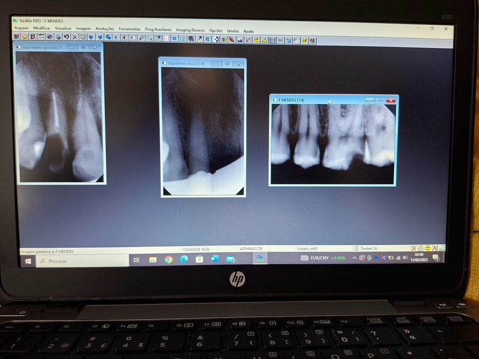 Sensor RVG Gendex + PC portátil - Radiografia dentária digital