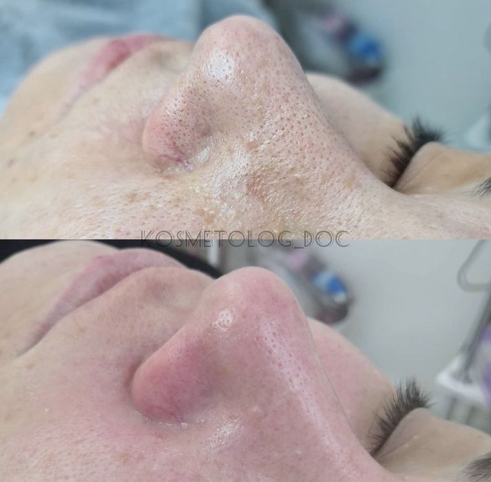 Косметолог, эпиляция