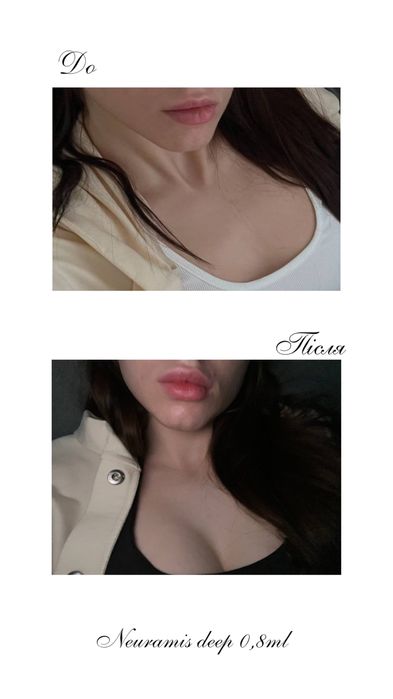 Ботокс чоло-1900 грн!Біоревіталізація, збільшення губ Одеса, центр