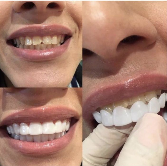 Виниры! Скорая помощь для Вашей красивой улыбки!