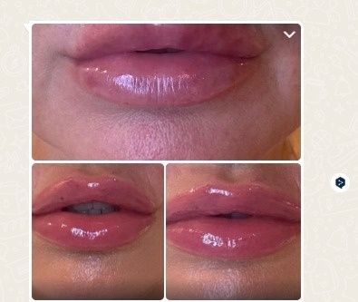 Harmonização facial não invasiva.