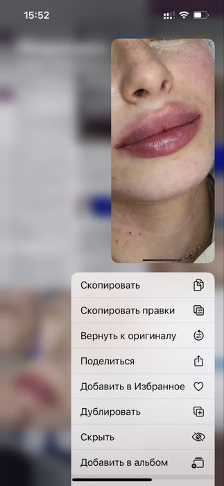 Увеличение губ 1800 грн Контурная пластика | Ботулинотерапия