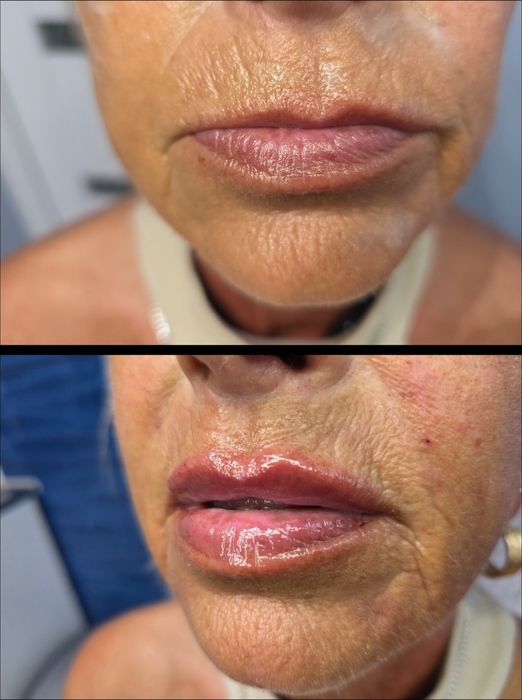 Promocja botox 1 okolica 150zł , usta 370