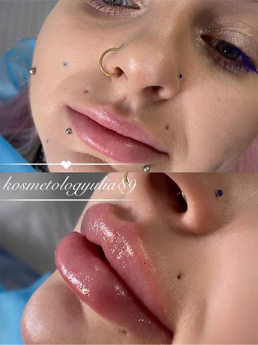 Акция! Увеличение губ Sardenya Deep от 2000 грн