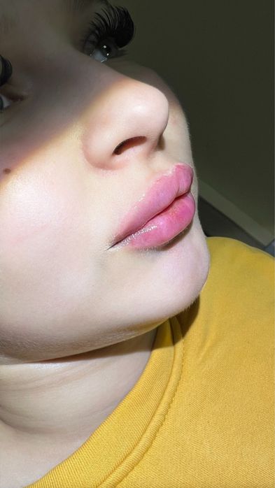 Лікар косметолог іньʼєкционіст АКЦИЯ ! Губы 1800/2000/3500/4400