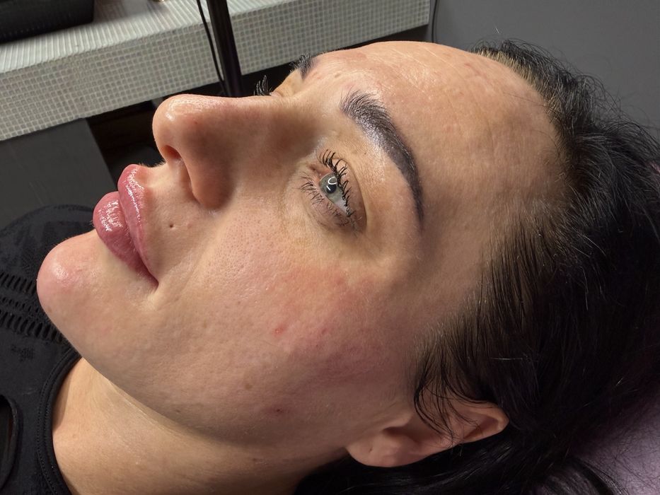 Powiększanie Ust 550 zł Russian Lips  BOTOX 500 zł