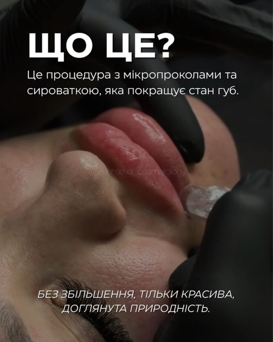 Мікронідлінг губ HYDRA LIPS - Безінʼєкційне зволоження!