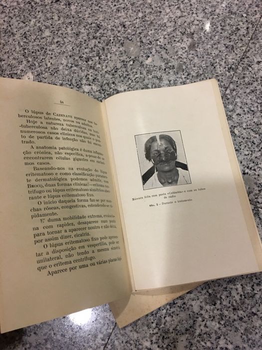O Lúpus, seu tratamento pelo rádio, edição de março de 1925