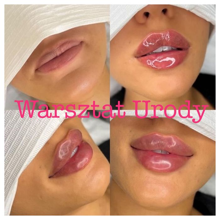 300zł= Kwas Hialuronowy Powiększenie Ust / Wolumetria 250z/ BOTOKS 200