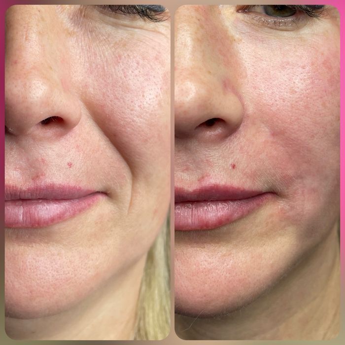 Збільшення губ , ботокс, косметолог