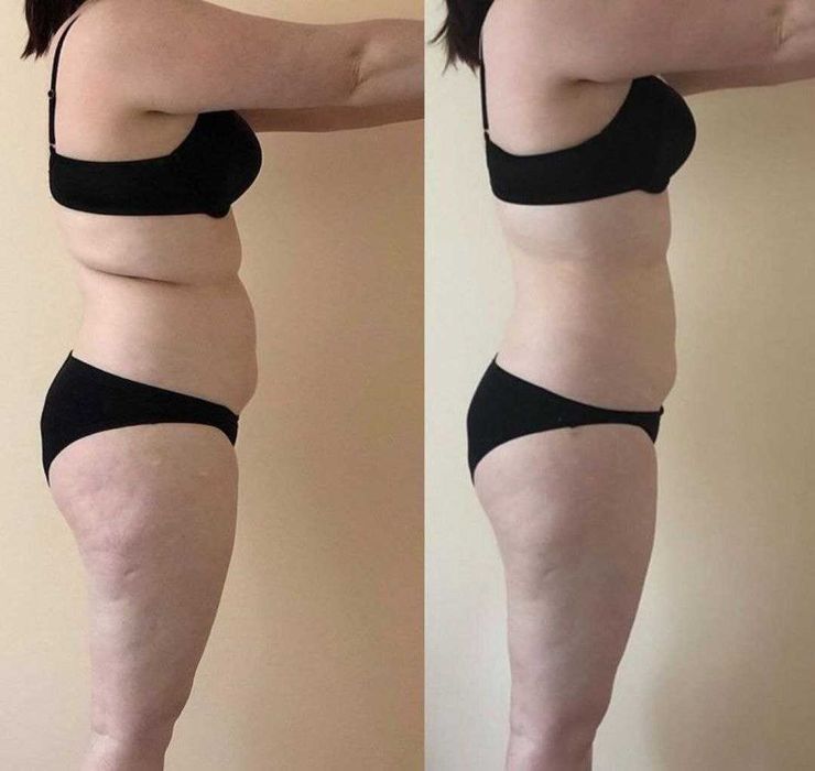 Антицелюлітний вакуумний масаж  • Апаратні методики • Масаж обличчя