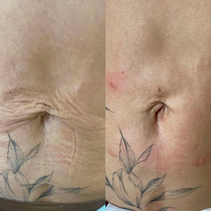 Косметолог моделі на(губи,ботокс,смас,рф голка,схуднення,худе обличчя)