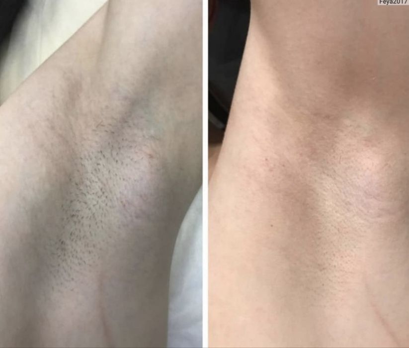 Массаж/ коррекция фигуры/ лазерная эпиляция/поселок Котовского