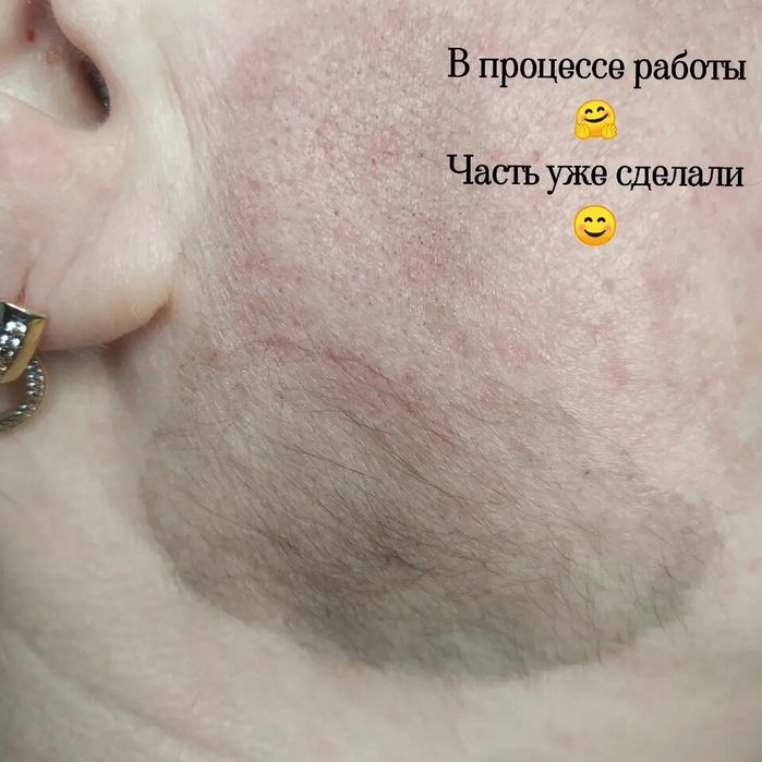 Электроэпиляция, центр города