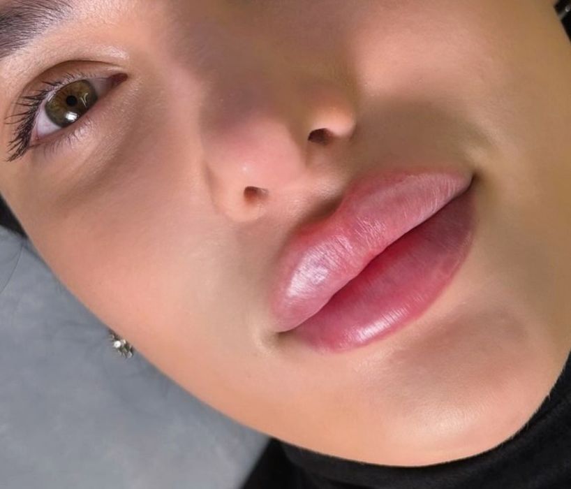 Акція!!Збільшення губ від 2500 грн,Ботокс