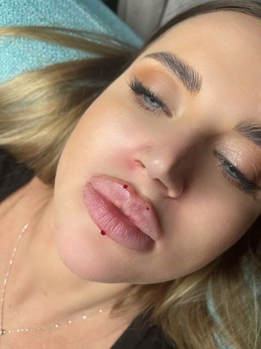 Косметолог. Акция 5 процедур по цене препарата