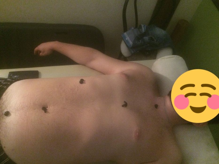 П'явки для лікування