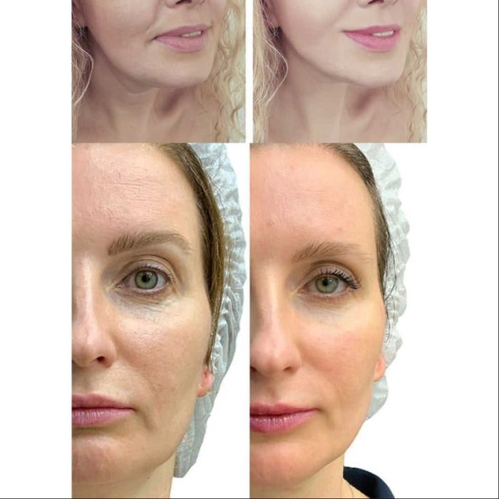 Мікрострумовий RF Lifting Масажер для обличчя Skin Lifting 7.0 Pink -