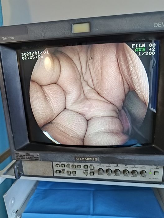 Процесор Fujinon epx 2200 з колоноскопом та монітором.