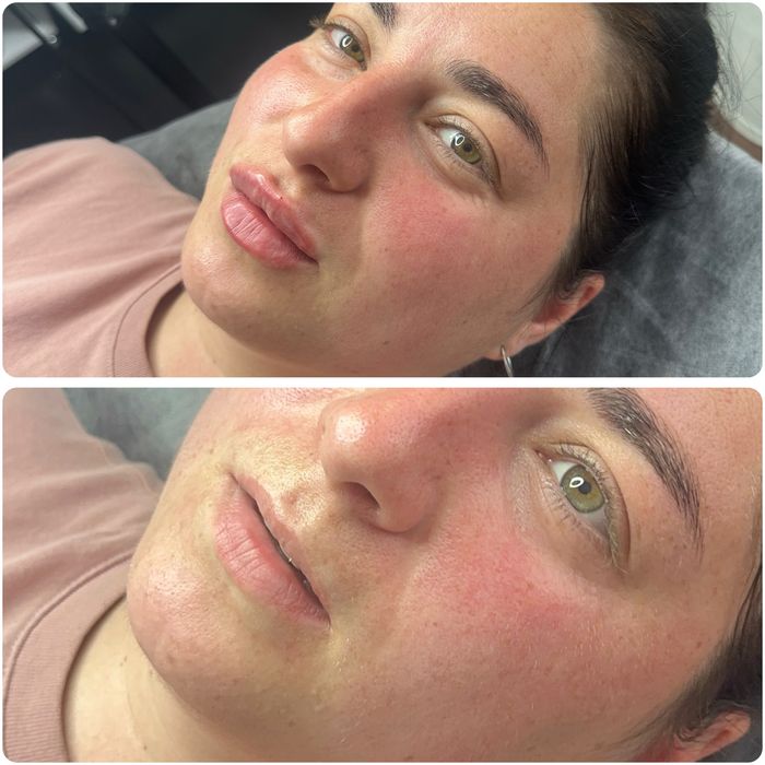 Увеличение губ и ботокс