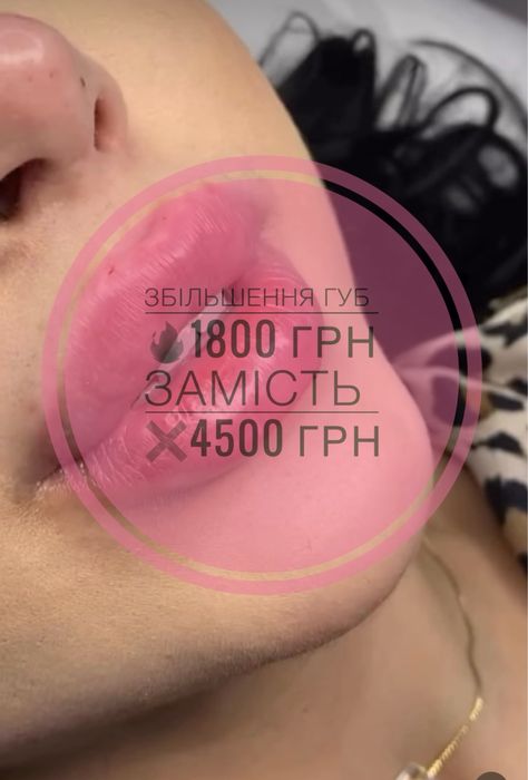 Увеличение губ 1800 грн Контурная пластика | Ботулинотерапия