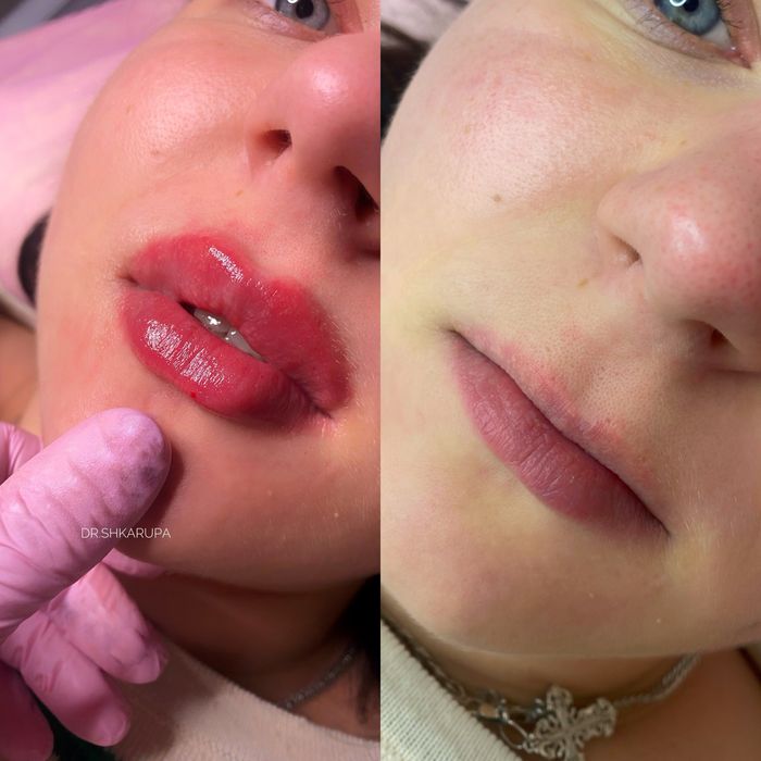 АКЦІЯ! Контурна пластика губ / збільшення губ / увеличение губ