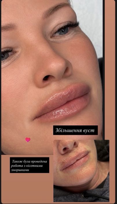 Контурная пластика губ