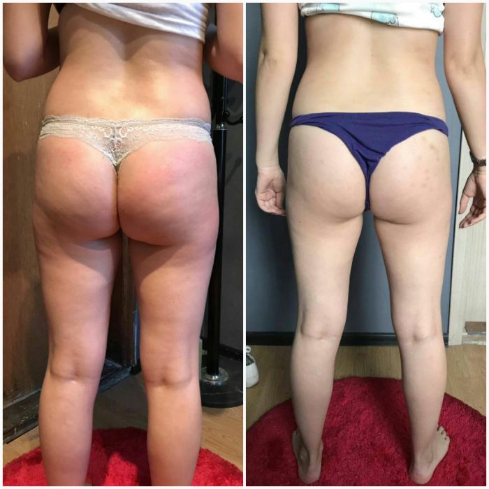 Вакумний антицелюлітний масаж