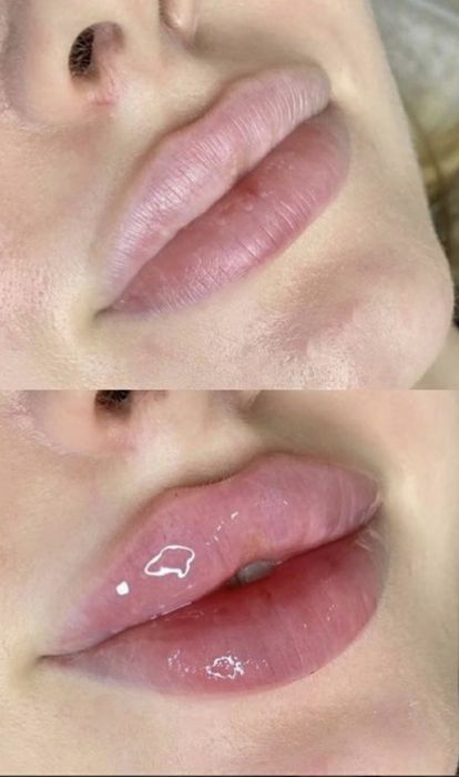 Губки ботокс гусинные лапки