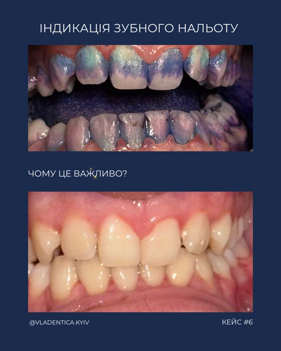 Стоматолог . Оболонь. Лікування карієсу, проф. гігієна , відбілювання