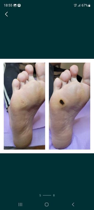 PODOLOG MOBILNY  Rataje  CAŁY POZNAŃ dla Seniorów Dojaz Pedicure