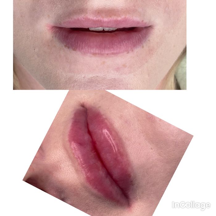 Modelowanie ust, botox ,nici, stymulatory, lipoliza !