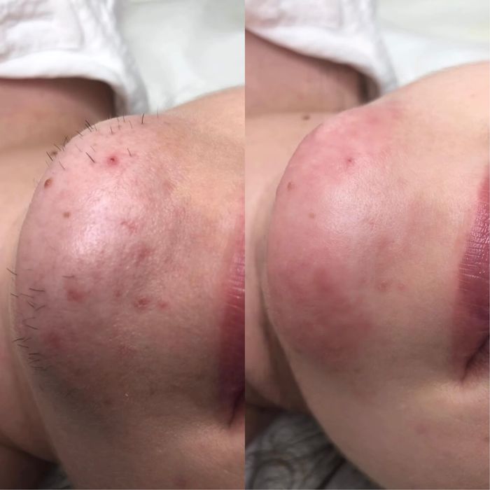 Електроепіляція обличчя Рівне | Видалення волосся назавжди