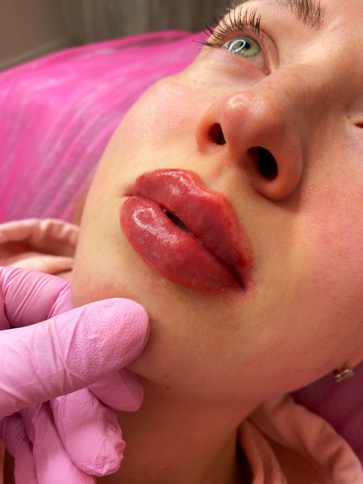 Акція! Stylage M / Контурна пластика губ /увеличение губ