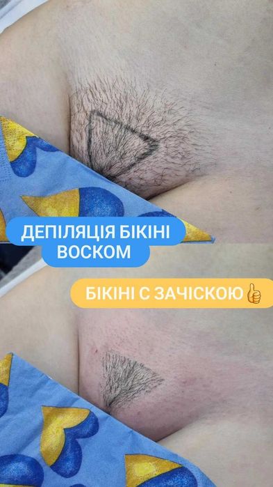 Шугаринг.  Воск. Депиляция . Лазерная  эпиляция. Дніпро, центр
