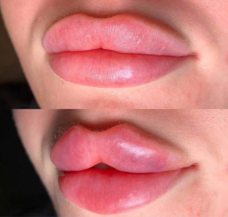 Похудение,ботокс,губы,рф,смасс,косметолог