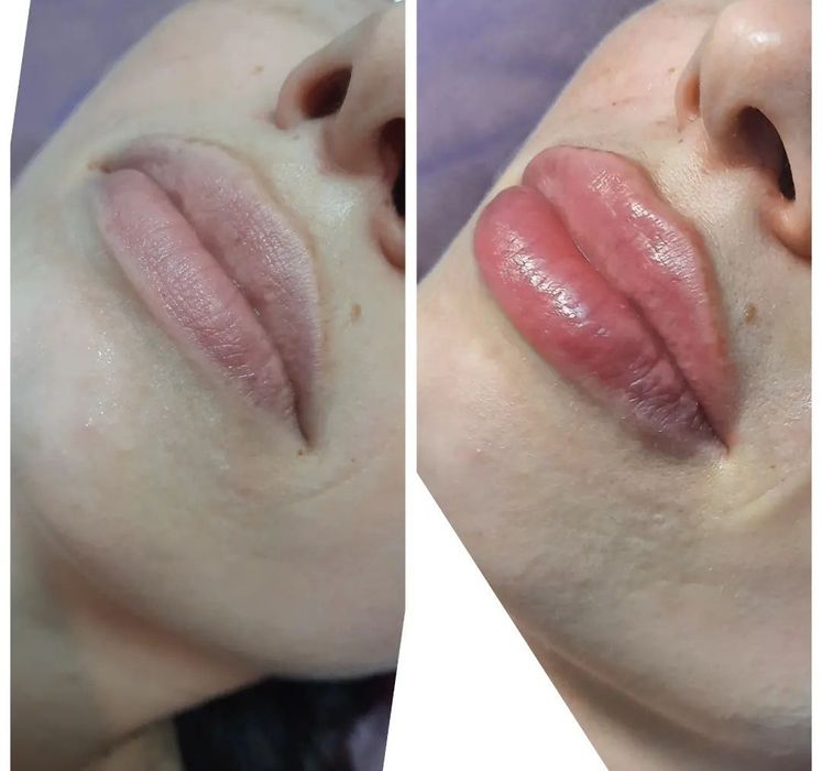 Косметолог Чистка лица Пилинг Rf лифтинг