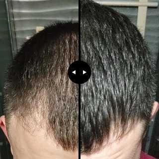 Minoxidil Kirkland - Resultados garantidos para cabelo e barba