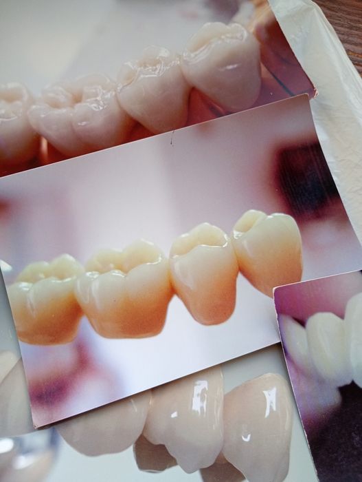 Стоматологія. Металокераміка, циркон, протези , пластмаса.