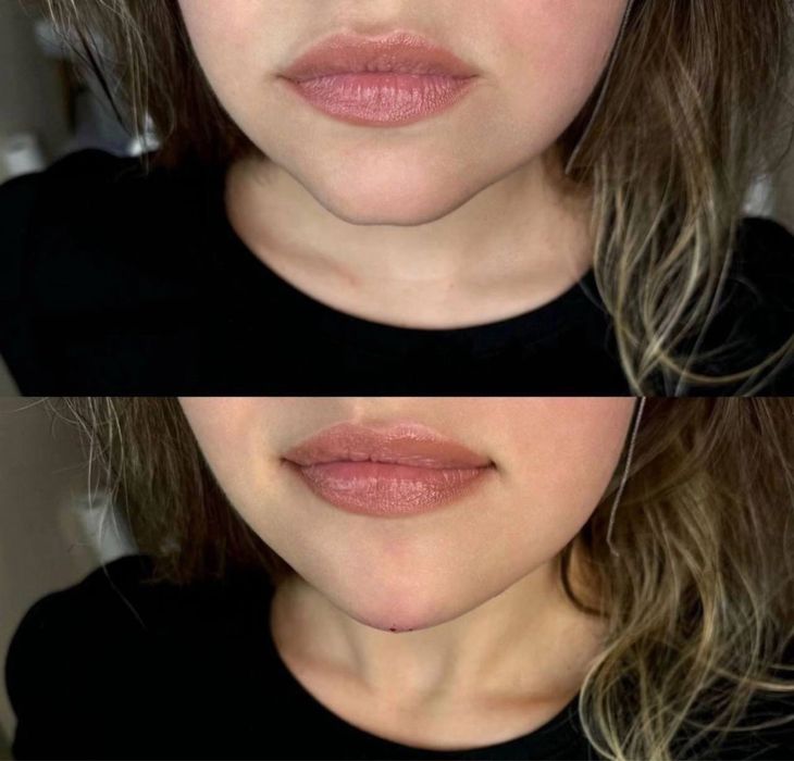 Похудение,ботокс,губы,рф,смасс,косметолог